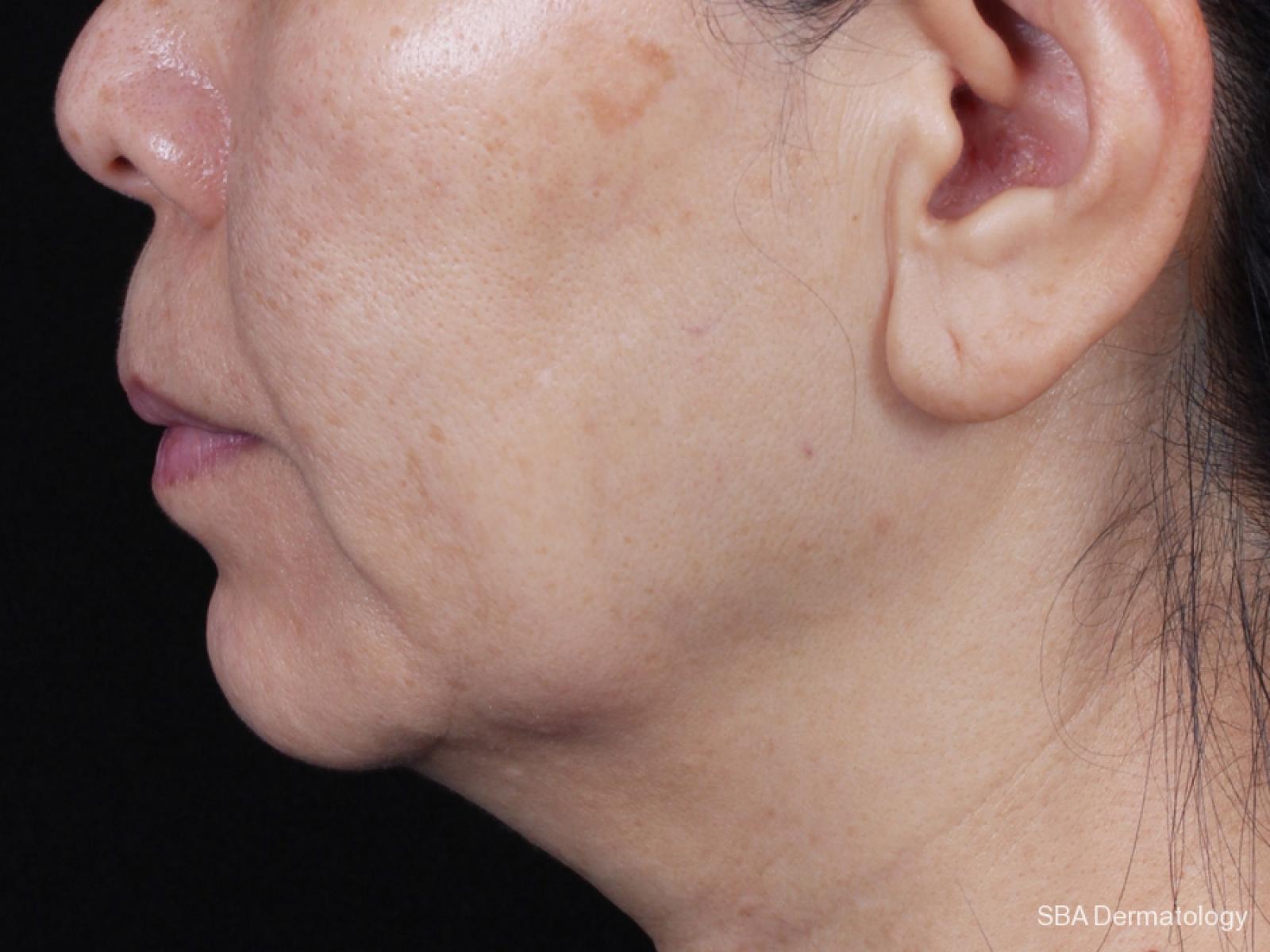 Kybella- Face: Patient 3 - Before 