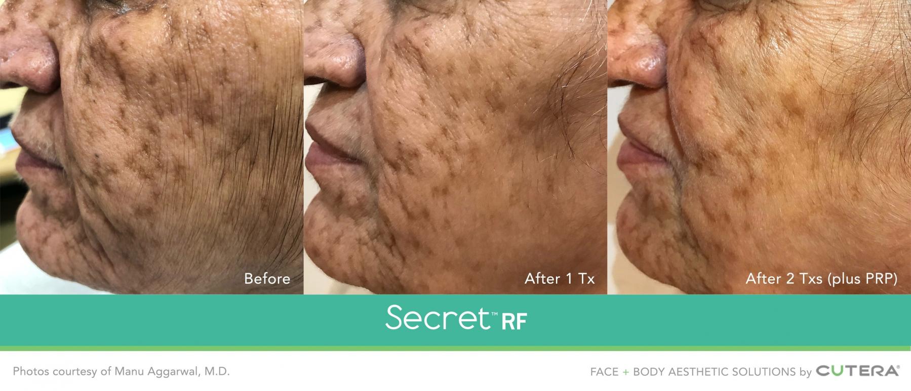 Secret RF: Patient 8 - Before and After  
