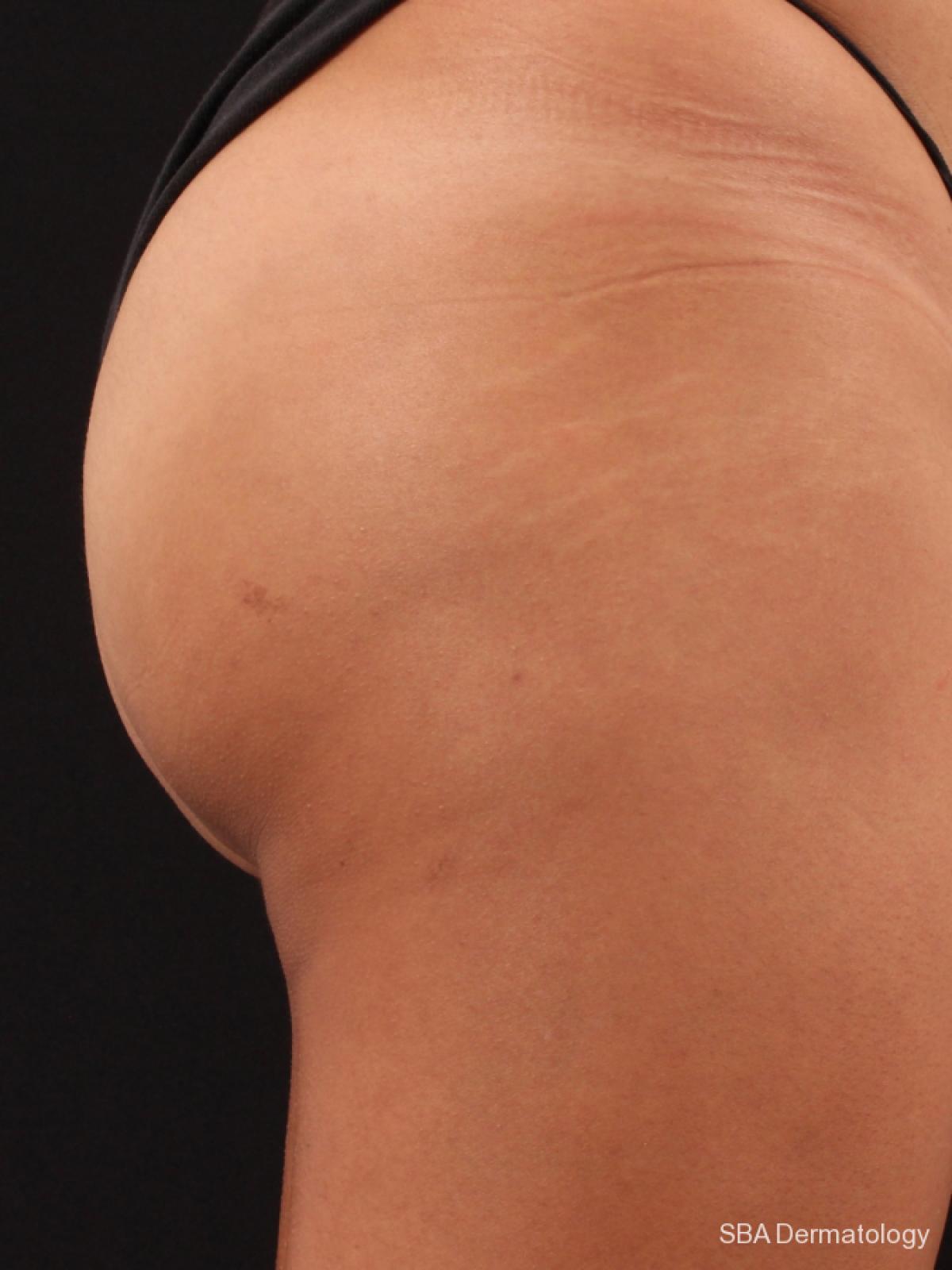 Sculptra-Body: Patient 2 - After 1