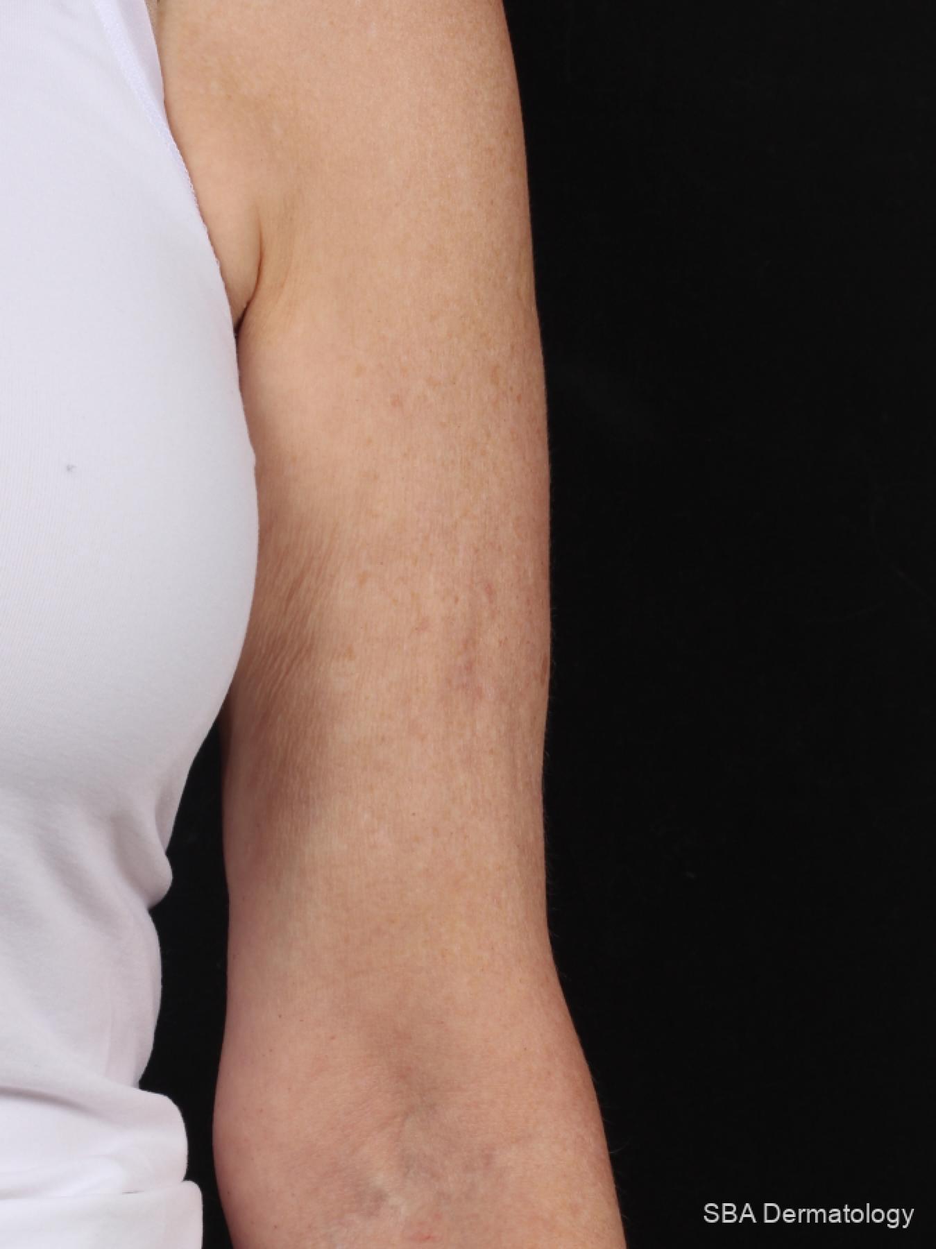 Velashape: Patient 2 - After 1