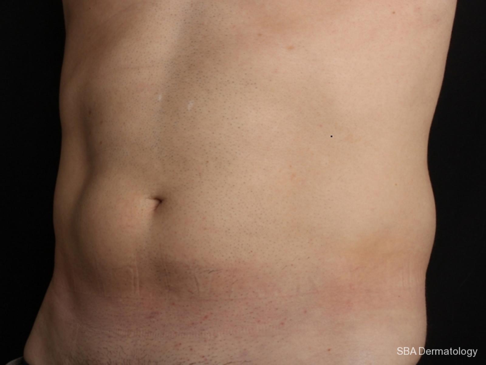 Coolsculpting: Patient 2 - After  