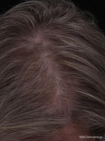 PRP For Hair Loss: Patient 3 - After 1