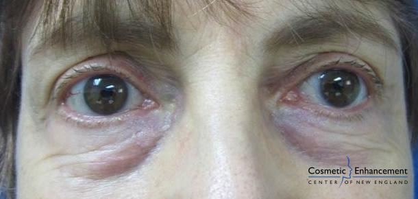 Sculptra: Patient 5 - After  