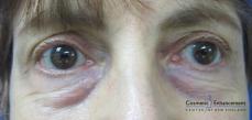 Sculptra: Patient 5 - After 