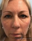 Voluma™ XC : Patient 1 - After 