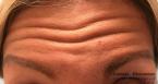BOTOX® Cosmetic: Patient 2 - Before 