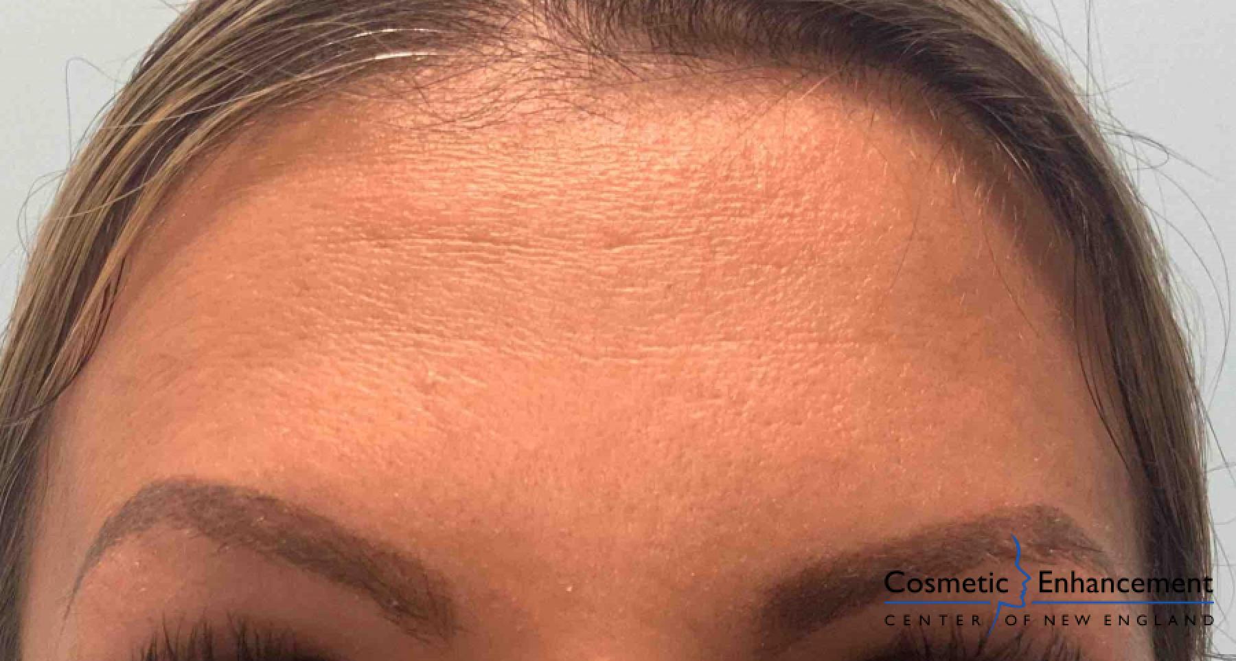 BOTOX® Cosmetic: Patient 2 - After  