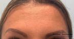BOTOX® Cosmetic: Patient 2 - After 