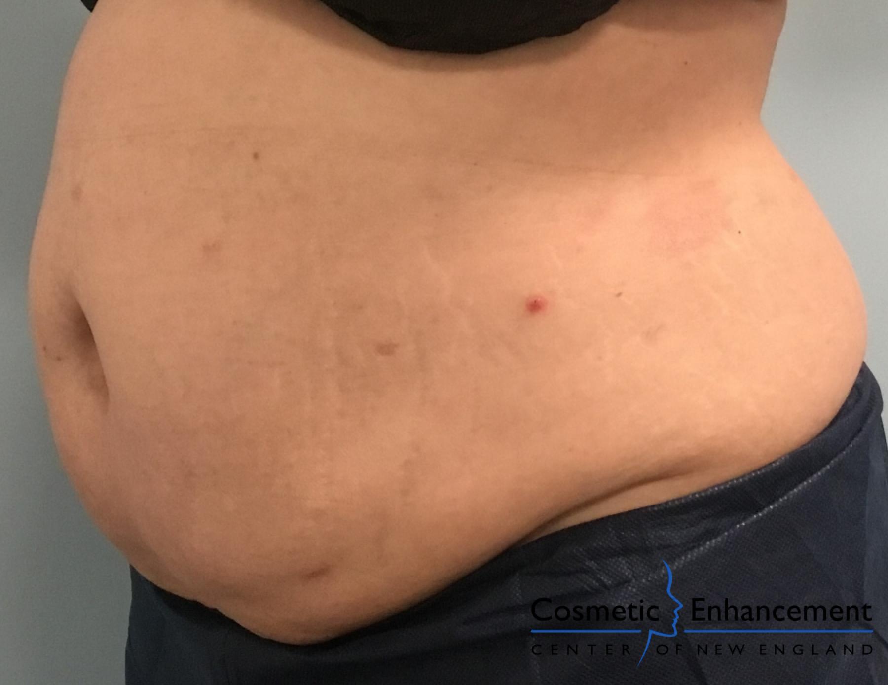 CoolSculpting®: Patient 9 - After  