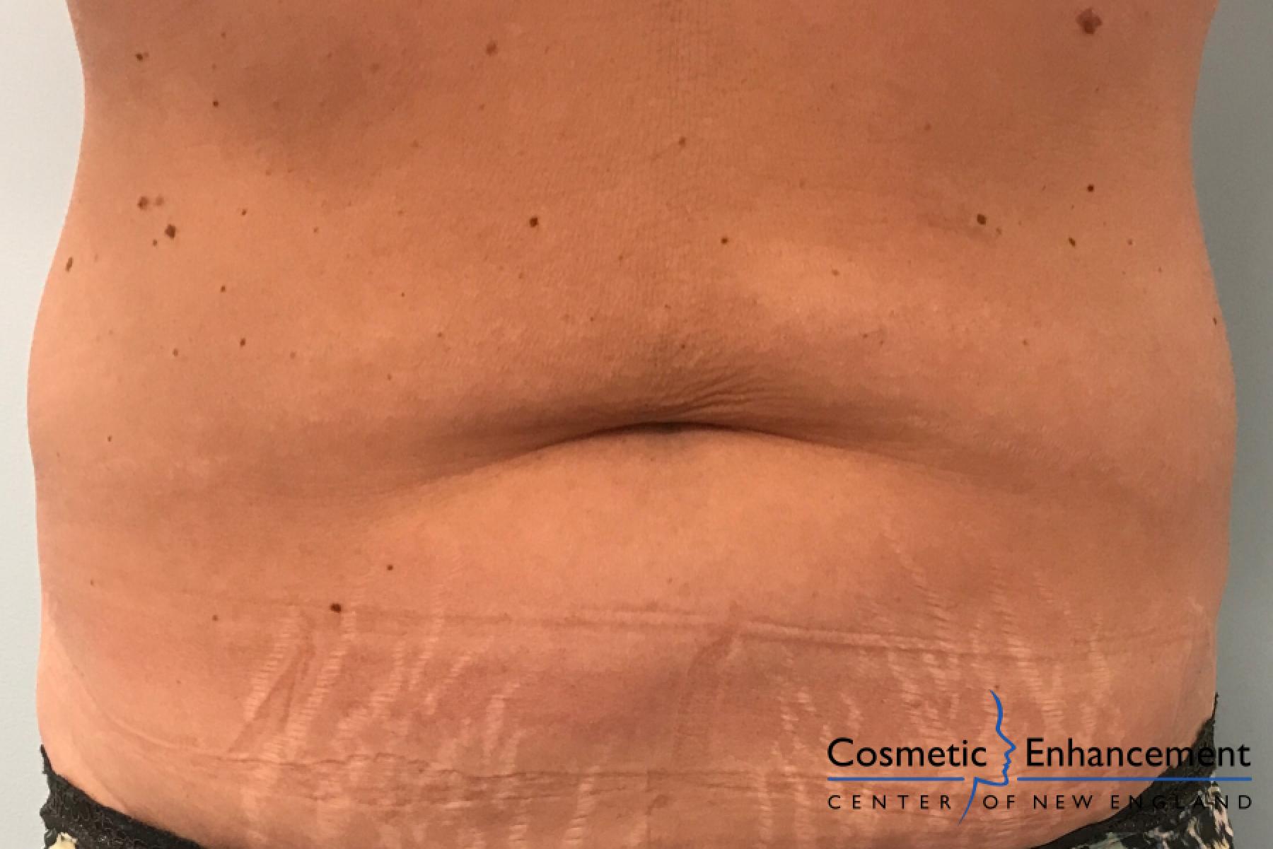 CoolSculpting®: Patient 10 - After  
