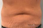 CoolSculpting®: Patient 10 - After 