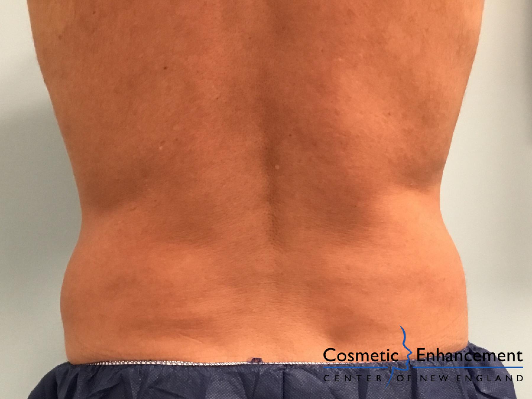 CoolSculpting®: Patient 20 - Before 1