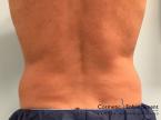 CoolSculpting®: Patient 20 - Before 