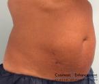 CoolSculpting®: Patient 18 - After 