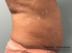 CoolSculpting®: Patient 23 - After 