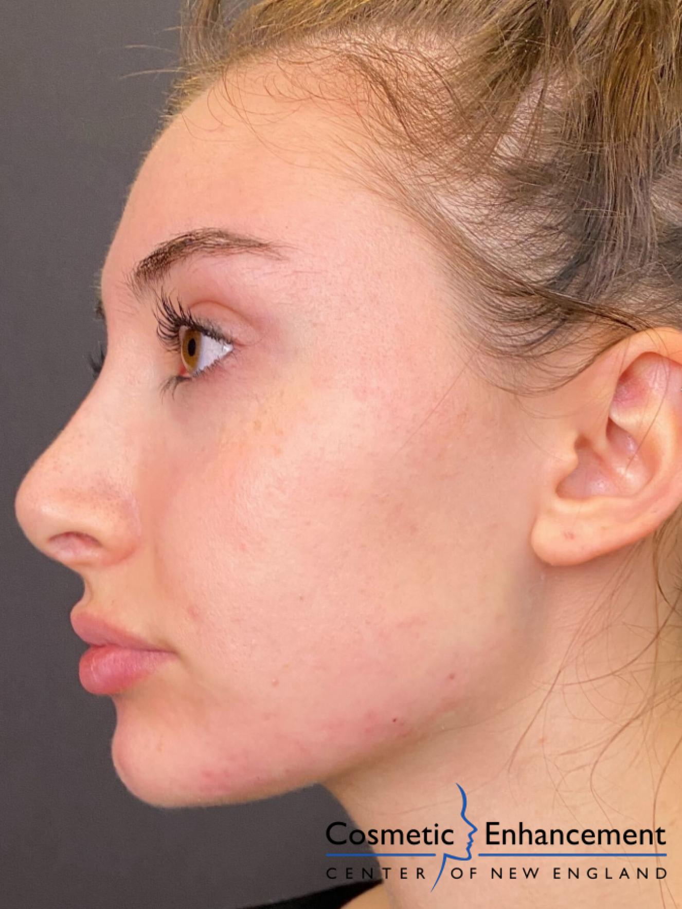 Fillers: Patient 6 - After  