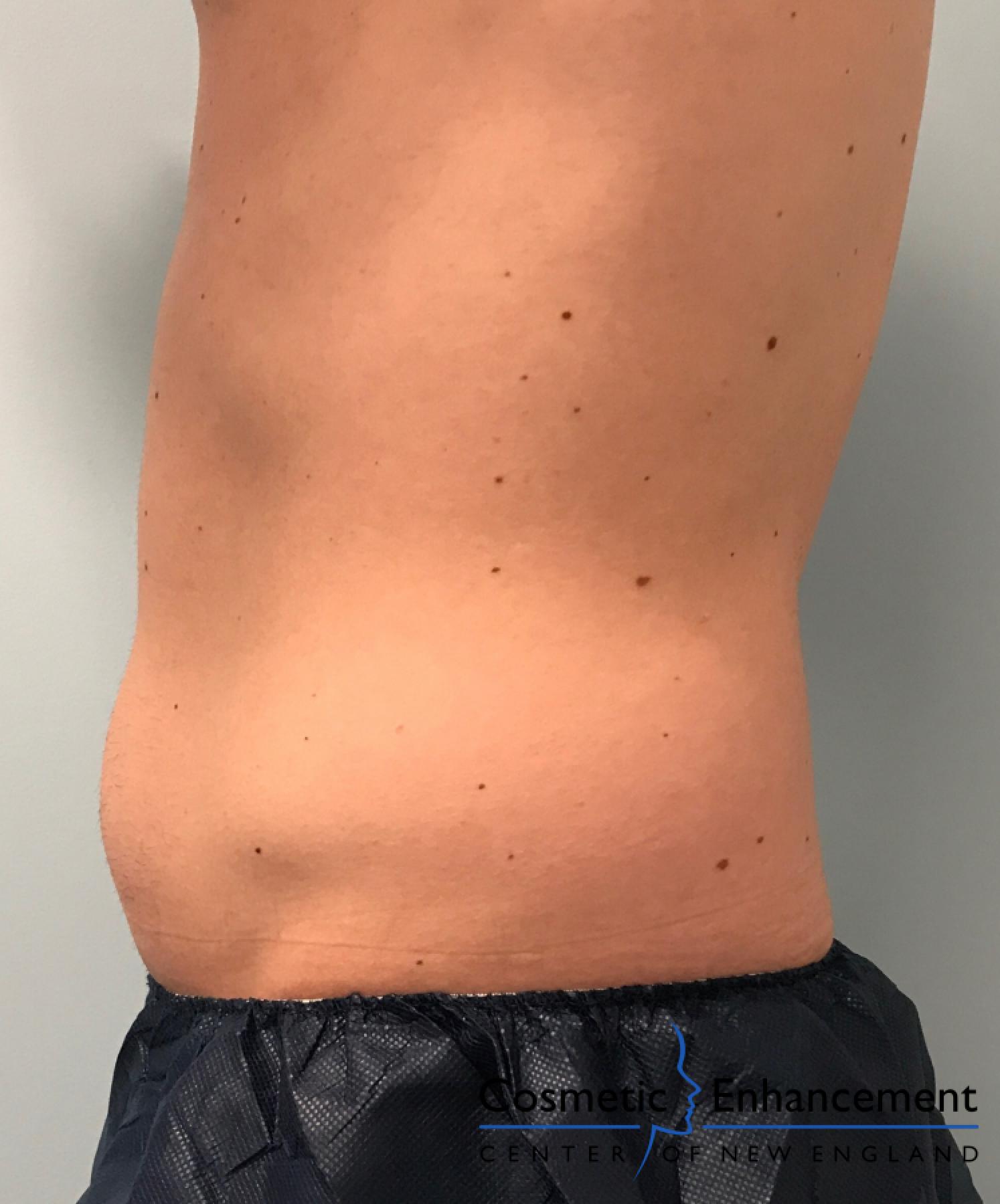 CoolSculpting®: Patient 13 - Before 1