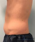 CoolSculpting®: Patient 13 - Before 