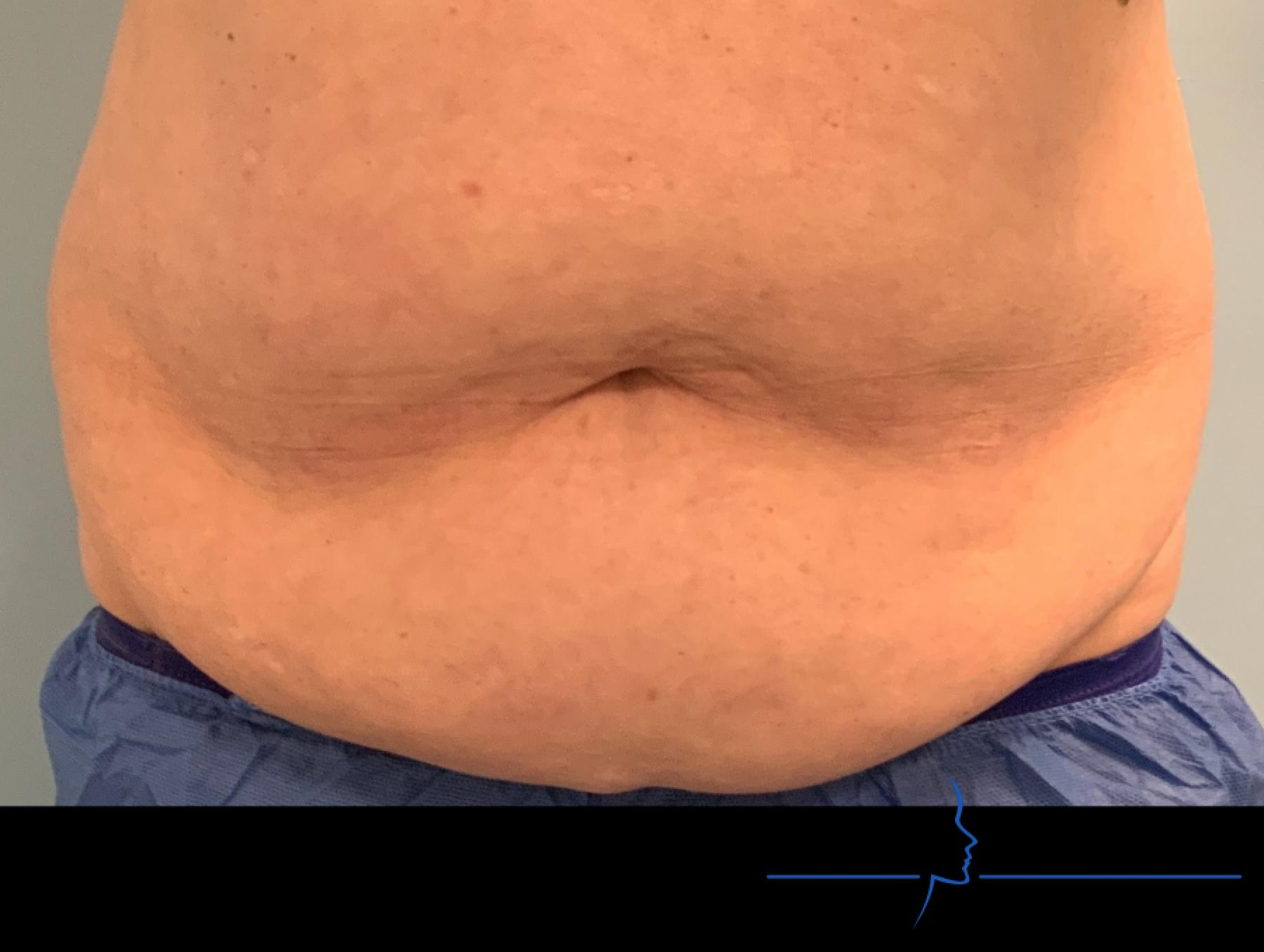 CoolSculpting®: Patient 4 - After  