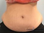 CoolSculpting®: Patient 15 - Before 