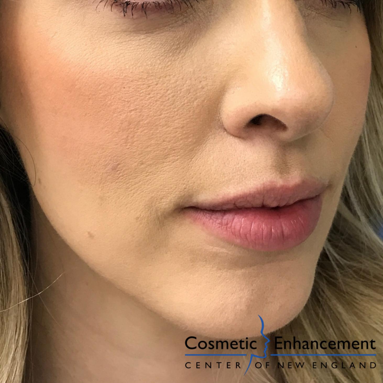 Fillers: Patient 2 - Before 