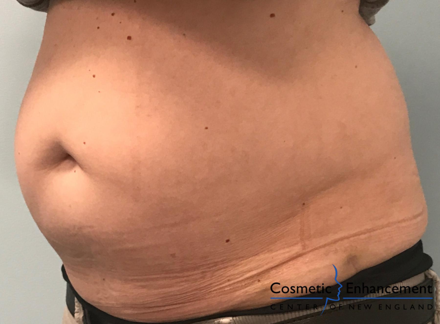 CoolSculpting®: Patient 3 - Before 