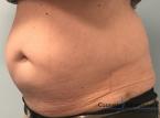 CoolSculpting®: Patient 3 - Before Image 