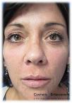 Vampire Facelift: Patient 3 - After Image 