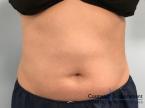 CoolSculpting®: Patient 21 - After 