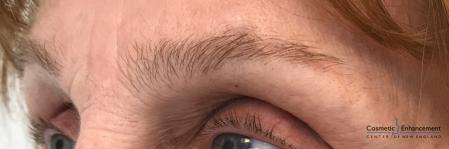 Microblading: Patient 5 - Before and After Image 3