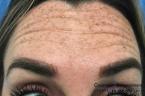 BOTOX® Cosmetic: Patient 4 - Before 