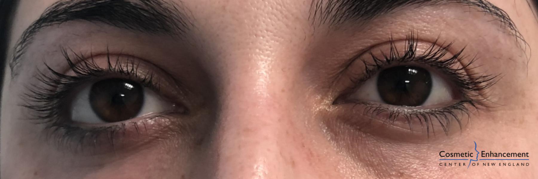 Lash Lift And Tint: Patient 1 - Before 
