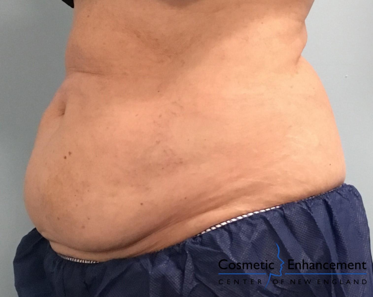 CoolSculpting®: Patient 11 - Before 1