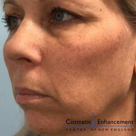 Voluma™ XC: Patient 1 - After Image 2