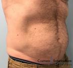 CoolSculpting®: Patient 17 - After 