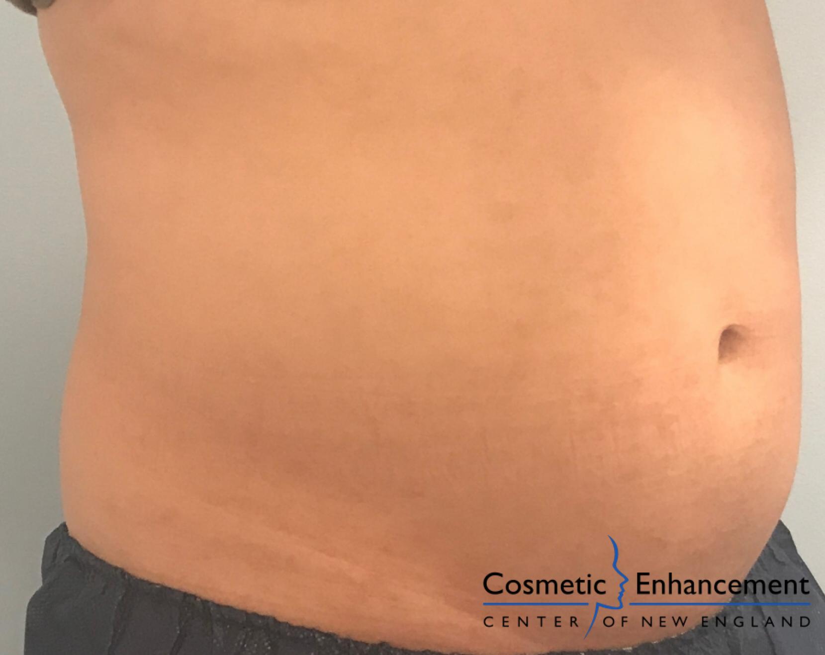 CoolSculpting®: Patient 6 - After  