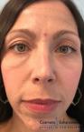 Fillers: Patient 1 - Before Image 
