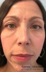 Fillers: Patient 1 - Before 