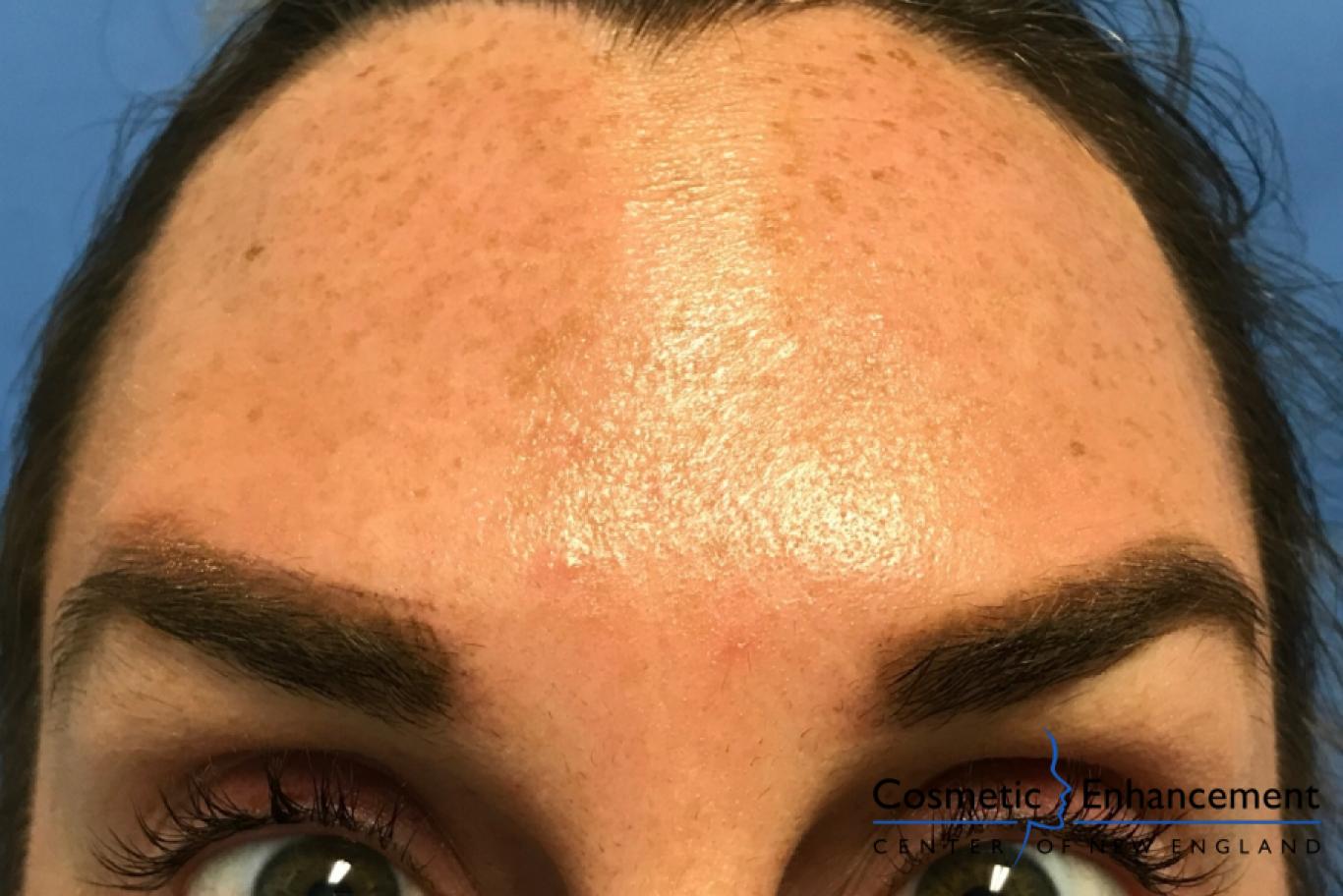 BOTOX® Cosmetic: Patient 4 - After  