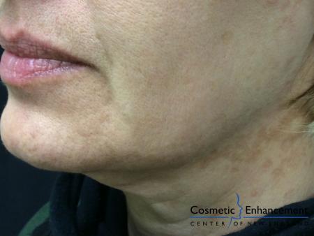 Ultherapy®: Patient 3 - Before Image 1