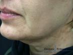Ultherapy®: Patient 3 - Before Image 