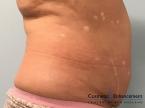 CoolSculpting®: Patient 23 - Before Image 
