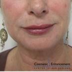 Vampire Facelift: Patient 5 - After Image 