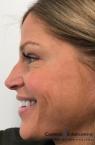 BOTOX® Cosmetic: Patient 1 - After 