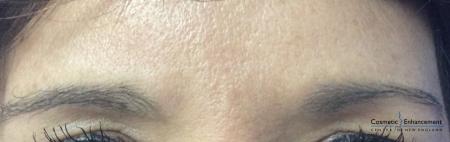 Ultherapy®: Patient 6 - Before Image 1