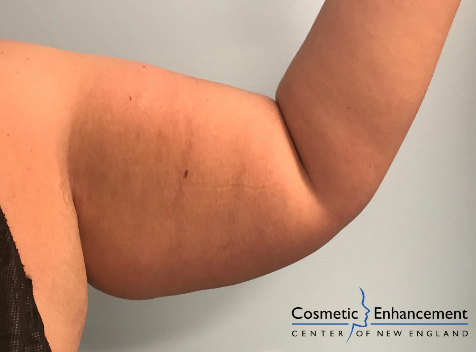 CoolSculpting®: Patient 12 - Before 1