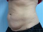 CoolSculpting®: Patient 26 - After 