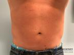 CoolSculpting®: Patient 22 - After 