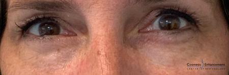 Ultherapy®: Patient 5 - After Image 1