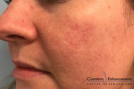 Vbeam: Patient 1 - Before Image 1